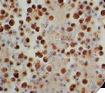 HHV-8 / HHV8 / KSHV Antibody - IHC of HHV-8 on FFPE Infected Pleura tissue.