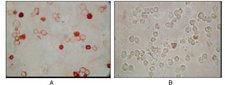 HHV-8 ORF62 Antibody - ICC of TPA induced BCBL-1 cells (A) and uninduced BCBL-1 cells (B) using KSHV ORF62 mouse monoclonal antibody with AEC staining.