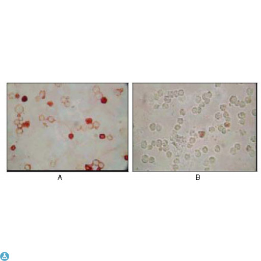 HHV-8 ORF62 Antibody - Immunocytochemistry (ICC) analysis of TPA induced BCBL-1 cells (A) and uninduced BCBL-1 cells (B) using KSHV ORF62 Monoclonal Antibody with AEC staining.