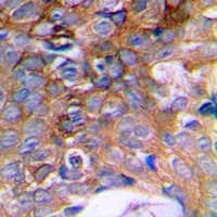 HIBADH Antibody - Immunohistochemical analysis of HIBADH staining in human prostate cancer formalin fixed paraffin embedded tissue section. The section was pre-treated using heat mediated antigen retrieval with sodium citrate buffer (pH 6.0). The section was then incubated with the antibody at room temperature and detected using an HRP conjugated compact polymer system. DAB was used as the chromogen. The section was then counterstained with hematoxylin and mounted with DPX.