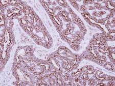 HIBADH Antibody - IHC of paraffin-embedded Breast ca, using HIBADH antibody at 1:250 dilution.