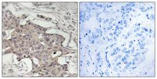 HIBADH Antibody - Peptide - + Immunohistochemistry analysis of paraffin-embedded human breast carcinoma tissue using HIBADH antibody.