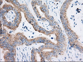 HIBCH Antibody - IHC of paraffin-embedded Adenocarcinoma of Human colon tissue using anti-HIBCH mouse monoclonal antibody. (Dilution 1:50).