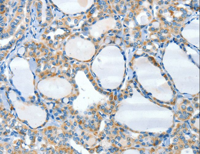 HID1 / C17orf28 Antibody - Immunohistochemistry of paraffin-embedded Human thyroid cancer using HID1 Polyclonal Antibody at dilution of 1:50.