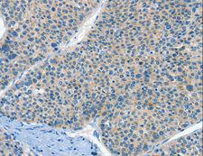 HID1 / C17orf28 Antibody - Immunohistochemistry of paraffin-embedded Human liver cancer using HID1 Polyclonal Antibody at dilution of 1:50.