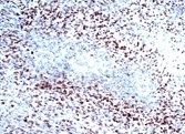 HIF1A / HIF1 Alpha Antibody - HIF-1 alpha Antibody (H1alpha67) - IHC of human glioblastoma multiforme. This image was taken for the unconjugated form of this product. Other forms have not been tested.