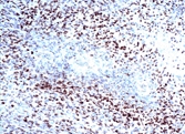 HIF1A / HIF1 Alpha Antibody - Immunohistochemical staining of human glioblastoma multiforme.  This image was taken for the unconjugated form of this product. Other forms have not been tested.