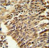 HIF1A / HIF1 Alpha Antibody - HIF1Alpha Antibody IHC of formalin-fixed and paraffin-embedded lung carcinoma followed by peroxidase-conjugated secondary antibody and DAB staining. This data demonstrates the use of the HIF1Alpha Antibody for immunohistochemistry.