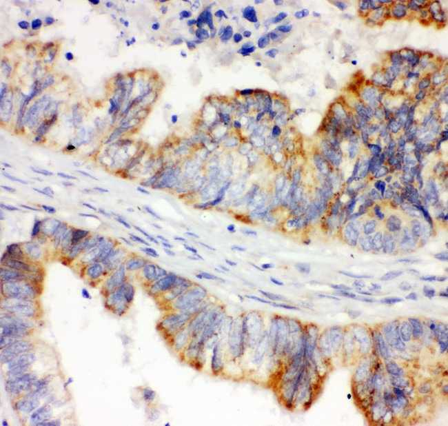 HIF1A / HIF1 Alpha Antibody - HIF 1 alpha antibody IHC-paraffin: Human Intestinal Cancer Tissue.