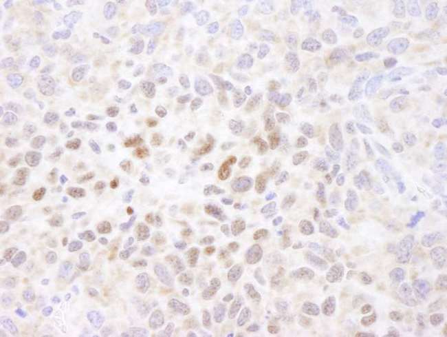 HIF1A / HIF1 Alpha Antibody - Detection of Mouse HIF1-alpha by Immunohistochemistry. Sample: FFPE section of mouse squamous cell carcinoma. Antibody: Affinity purified rabbit anti-HIF1-alpha used at a dilution of 1:250. Epitope Retrieval Buffer-High pH (IHC-101J) was substituted for Epitope Retrieval Buffer-Reduced pH.