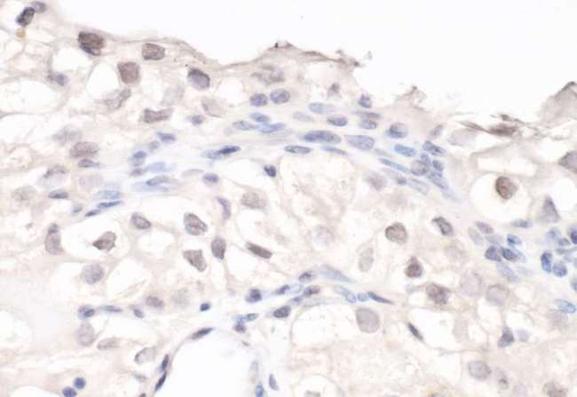 HIF1A / HIF1 Alpha Antibody - Detection of human HIF1-alpha by immunohistochemistry. Sample: FFPE section of renal cell carcinoma. Antibody: Affinity purified rabbit anti-HIF1-alpha antibody used at a dilution of 1:100. Detection: DAB