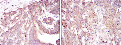 HIF1A / HIF1 Alpha Antibody - IHC of paraffin-embedded stomach cancer tissues (left) and brain tumor tissues (right) using HIF1A mouse monoclonal antibody with DAB staining.