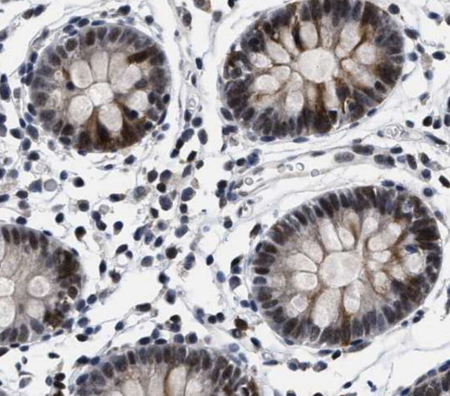 HIF1A / HIF1 Alpha Antibody - colon tissue HIF1A antibody used at 1:200 on formalin-fixed paraffin embedded tissue.