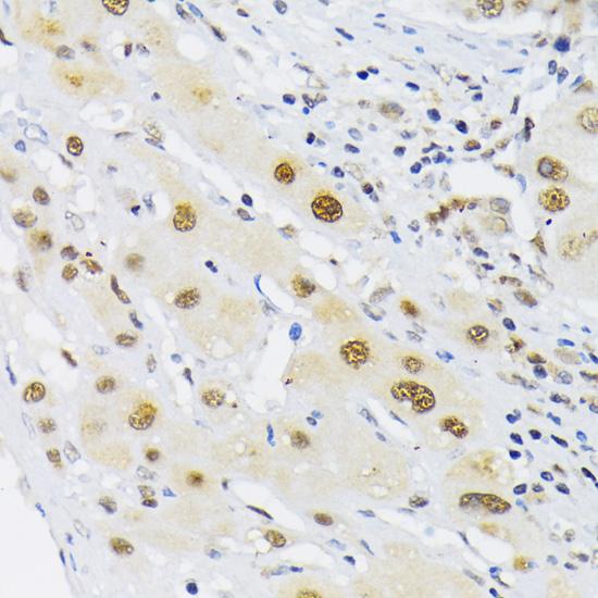 HIF1A / HIF1 Alpha Antibody - Immunohistochemistry of paraffin-embedded Human liver cancer using HIF1A Polyclonal Antibody at dilution of 1:200 (40x lens).