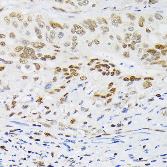 HIF1A / HIF1 Alpha Antibody - Immunohistochemistry of paraffin-embedded Human colon carcinoma using HIF1A Polyclonal Antibody at dilution of 1:200 (40x lens).