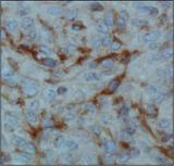 HIF1AN Antibody - Factor Inhibiting HIF-1 Antibody (162c) - IHC of FIH in human renal cancer using DAB with hematoxylin counterstain.  This image was taken for the unconjugated form of this product. Other forms have not been tested.
