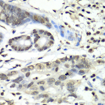 HIF1AN Antibody - Immunohistochemistry of paraffin-embedded human gastric cancer tissue.