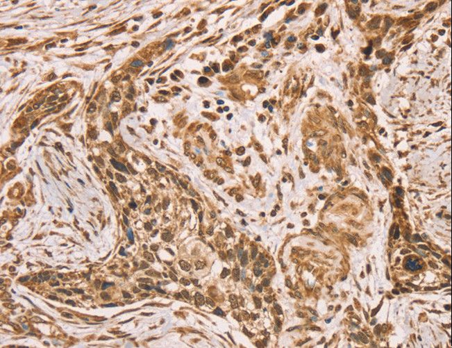HIF1AN Antibody - Immunohistochemistry of paraffin-embedded Human esophagus cancer using HIF1AN Polyclonal Antibody at dilution of 1:40.