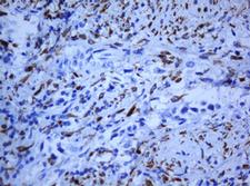 HIF3A / HIF3-Alpha Antibody - IHC of paraffin-embedded Carcinoma of Human bladder tissue using anti-HIF3A mouse monoclonal antibody. (Heat-induced epitope retrieval by 10mM citric buffer, pH6.0, 120°C for 3min).
