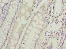 HIGD1B Antibody - Immunohistochemistry of paraffin-embedded human colon cancer using antibody at dilution of 1:100.