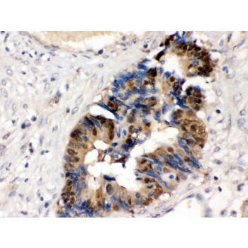 HINT / HINT1 Antibody - HINT1 antibody IHC-paraffin. IHC(P): Human Intestinal Cancer Tissue.