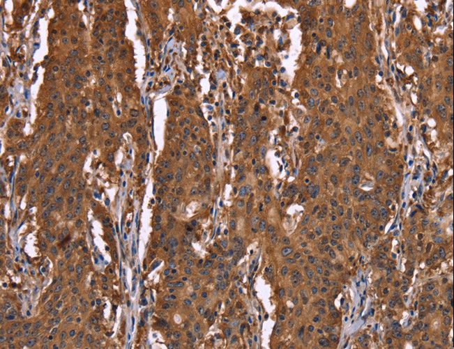 HINT / HINT1 Antibody - Immunohistochemistry of paraffin-embedded Human gastric cancer using HINT1 Polyclonal Antibody at dilution of 1:30.