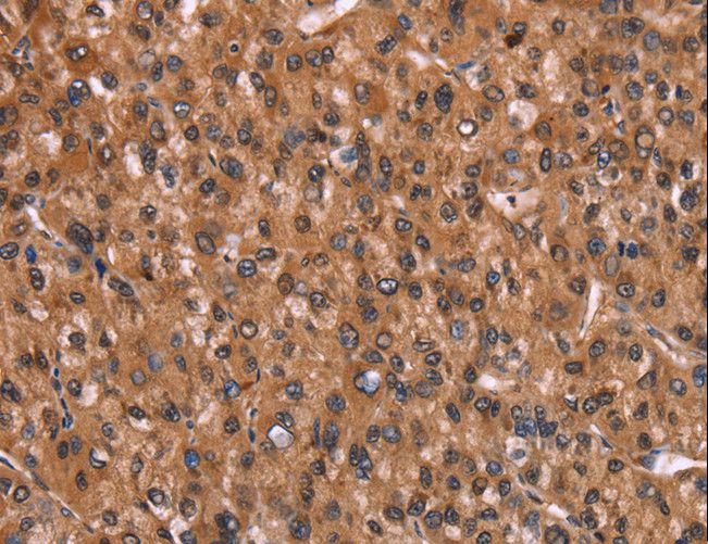 HINT / HINT1 Antibody - Immunohistochemistry of paraffin-embedded Human liver cancer using HINT1 Polyclonal Antibody at dilution of 1:30.