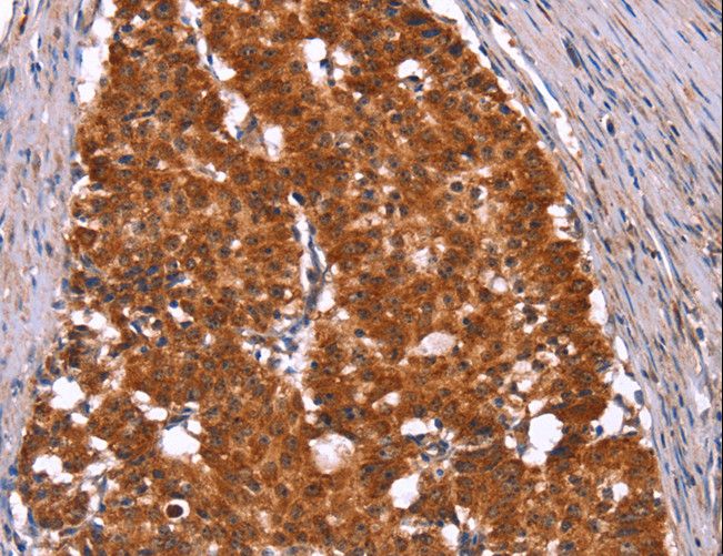 HINT / HINT1 Antibody - Immunohistochemistry of paraffin-embedded Human gastric cancer using HINT1 Polyclonal Antibody at dilution of 1:50.