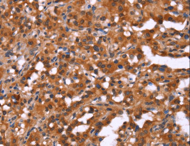 HINT / HINT1 Antibody - Immunohistochemistry of paraffin-embedded Human thyroid cancer using HINT1 Polyclonal Antibody at dilution of 1:50.