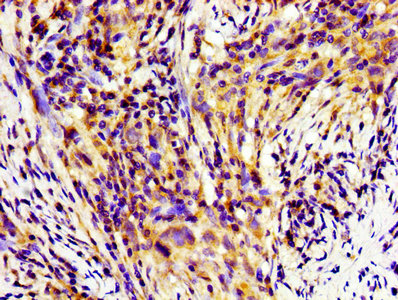 HINT / HINT1 Antibody - Immunohistochemistry of paraffin-embedded human pancreatic cancer using HINT1 Antibody at dilution of 1:100