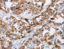 HINT2 Antibody - Immunohistochemistry of paraffin-embedded Human cervical cancer using HINT2 Polyclonal Antibody at dilution of 1:40.