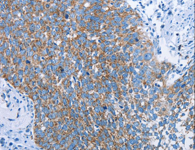 HINT2 Antibody - Immunohistochemistry of paraffin-embedded Human cervical cancer using HINT2 Polyclonal Antibody at dilution of 1:40.