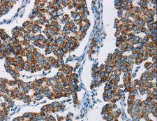 HINT2 Antibody - Immunohistochemistry of paraffin-embedded Human breast cancer using HINT2 Polyclonal Antibody at dilution of 1:50.
