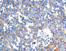 HINT2 Antibody - Immunohistochemistry of paraffin-embedded Human colon cancer using HINT2 Polyclonal Antibody at dilution of 1:60.