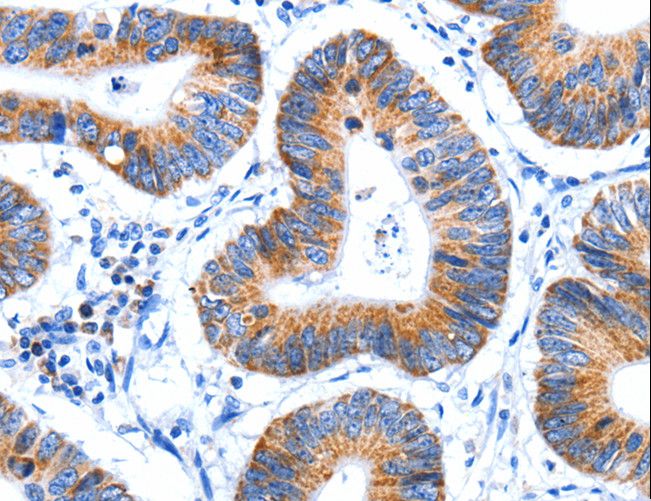 HINT2 Antibody - Immunohistochemistry of paraffin-embedded Human colon cancer using HINT2 Polyclonal Antibody at dilution of 1:60.