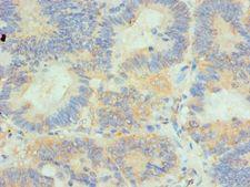 HIP1 Antibody - Immunohistochemistry of paraffin-embedded human colon cancer using antibody at 1:100 dilution.