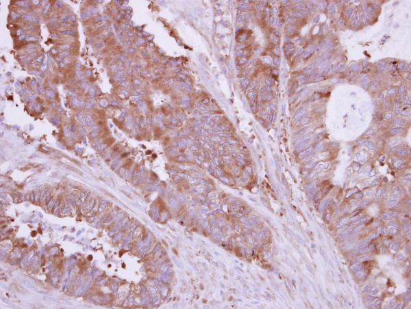 HIP1R Antibody - IHC of paraffin-embedded Colon ca, using HIP1 Related antibody at 1:500 dilution.