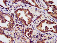 HIPK1 Antibody - Immunohistochemistry image at a dilution of 1:200 and staining in paraffin-embedded human lung cancer performed on a Leica BondTM system. After dewaxing and hydration, antigen retrieval was mediated by high pressure in a citrate buffer (pH 6.0) . Section was blocked with 10% normal goat serum 30min at RT. Then primary antibody (1% BSA) was incubated at 4 °C overnight. The primary is detected by a biotinylated secondary antibody and visualized using an HRP conjugated SP system.
