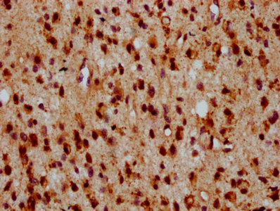 HIPK2 Antibody - Immunohistochemistry Dilution at 1:500 and staining in paraffin-embedded human glioma cancer performed on a Leica BondTM system. After dewaxing and hydration, antigen retrieval was mediated by high pressure in a citrate buffer (pH 6.0). Section was blocked with 10% normal Goat serum 30min at RT. Then primary antibody (1% BSA) was incubated at 4°C overnight. The primary is detected by a biotinylated Secondary antibody and visualized using an HRP conjugated SP system.