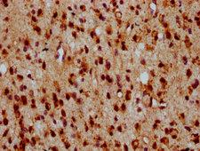 HIPK2 Antibody - Immunohistochemistry Dilution at 1:500 and staining in paraffin-embedded human glioma cancer performed on a Leica BondTM system. After dewaxing and hydration, antigen retrieval was mediated by high pressure in a citrate buffer (pH 6.0). Section was blocked with 10% normal Goat serum 30min at RT. Then primary antibody (1% BSA) was incubated at 4°C overnight. The primary is detected by a biotinylated Secondary antibody and visualized using an HRP conjugated SP system.