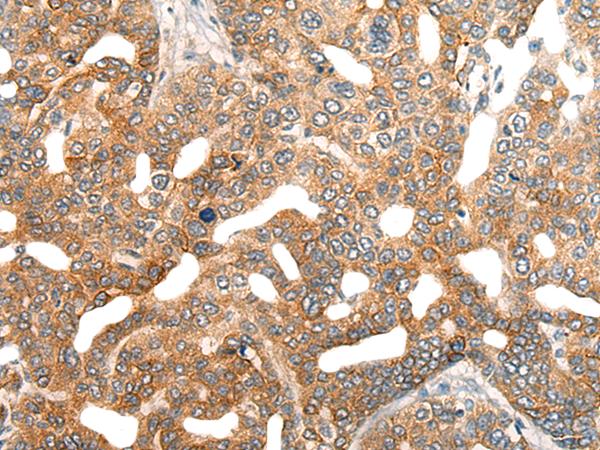 HIPK2 Antibody - Immunohistochemistry of paraffin-embedded Human liver cancer tissue  using HIPK2 Polyclonal Antibody at dilution of 1:40(×200)
