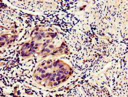HIPK3 / FIST Antibody - Immunohistochemistry image of paraffin-embedded human bladder cancer at a dilution of 1:100