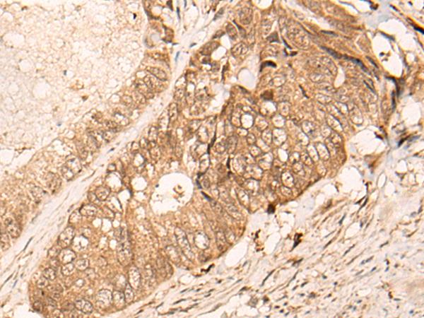 HIPK3 / FIST Antibody - Immunohistochemistry of paraffin-embedded Human colorectal cancer tissue  using HIPK3 Polyclonal Antibody at dilution of 1:60(×200)
