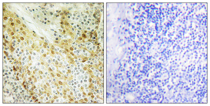HIRA Antibody - Immunohistochemistry analysis of paraffin-embedded human tonsil tissue, using HIRA Antibody. The picture on the right is blocked with the synthesized peptide.