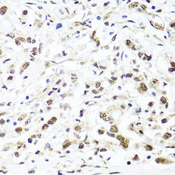 HIRA Antibody - Immunohistochemistry of paraffin-embedded human gastric cancer tissue.