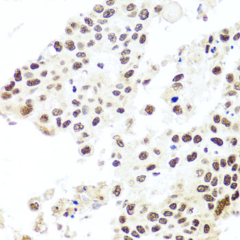 HIRA Antibody - Immunohistochemistry of paraffin-embedded human lung cancer tissue.