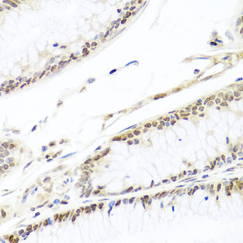 HIRA Antibody - Immunohistochemistry of paraffin-embedded human colon carcinoma tissue.
