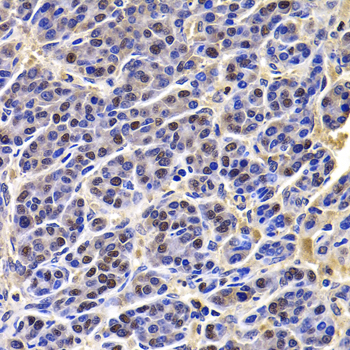 HIRIP3 Antibody - Immunohistochemistry of paraffin-embedded human liver cancer tissue.