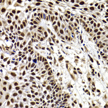 HIRIP3 Antibody - Immunohistochemistry of paraffin-embedded human well-differentiated squamous skin carcinoma tissue.