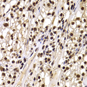 HIRIP3 Antibody - Immunohistochemistry of paraffin-embedded human kidney cancer tissue.